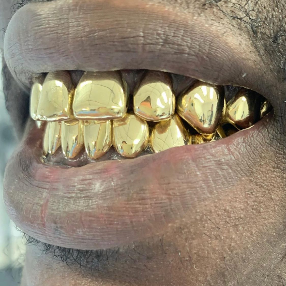 Miami Gold 10 Top 10 Bottom Custom Grillz