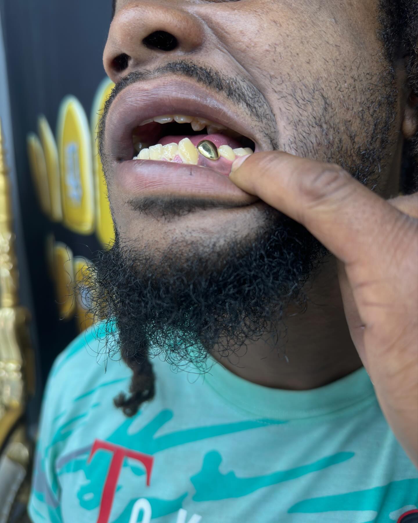Miami Gold Single Tooth Custom Grillz