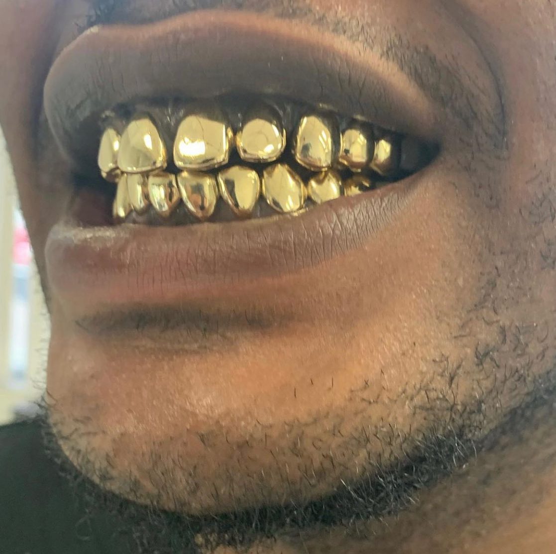 Miami Gold 10 Top 10 Bottom Custom Grillz