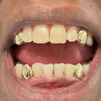 Miami Gold Two - Teeth Custom Grillz