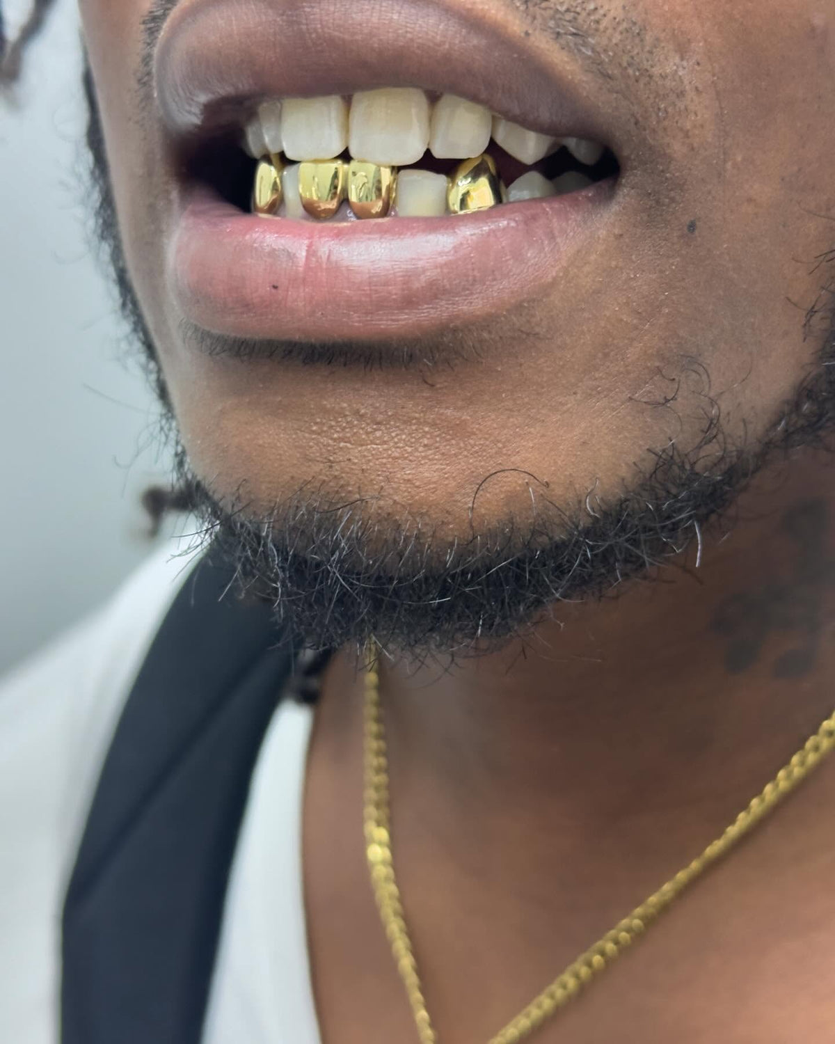 Miami Gold Four Piece Custom Grillz